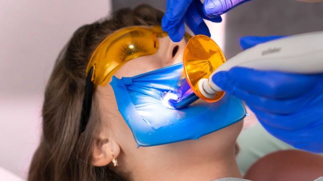 Cover otturazioni estetiche