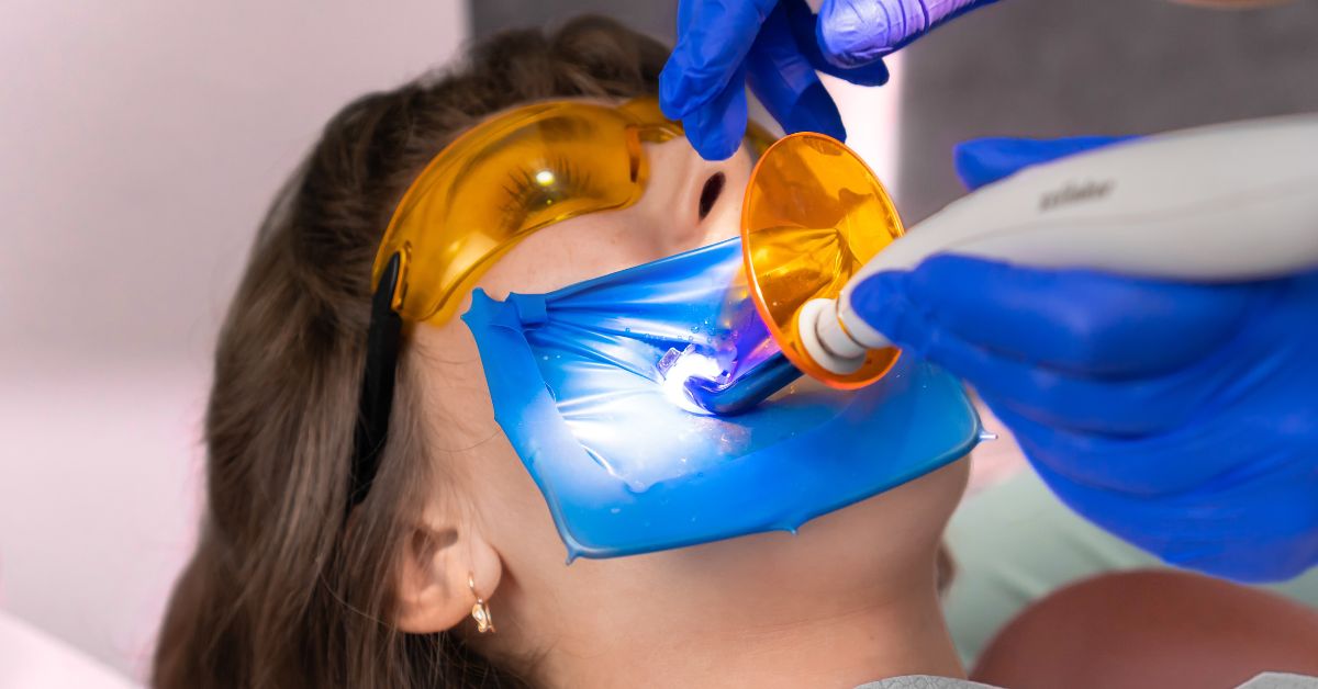 Cover otturazioni estetiche
