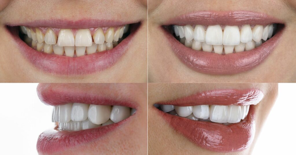 prima e dopo faccette dentali