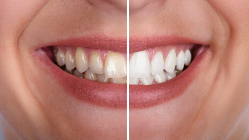 sbiancamento dentale prima e dopo il trattamento
